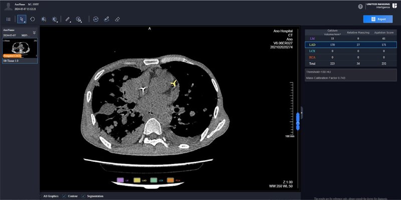 CT Nongated CACS
