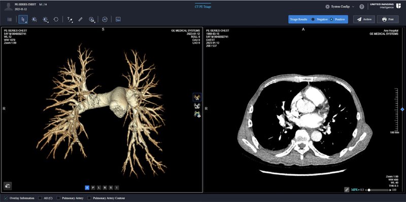 CT PE Triage