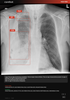 Carebot AI CXR - 2.8.XX_02