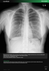 Carebot AI CXR - 2.8.XX_03