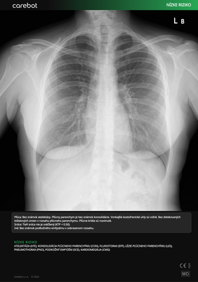 Carebot AI CXR - 2.8.XX_03