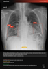 Carebot AI CXR - 2.8.XX_04
