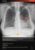 Carebot AI CXR - 2.8.XX_05