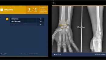 Commercially available artificial intelligence tools for fracture detection