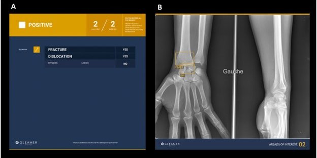 Commercially available artificial intelligence tools for fracture detection