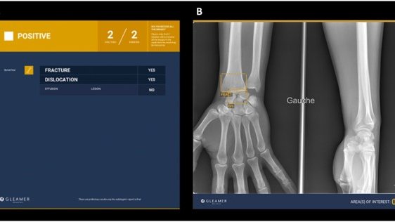 Commercially available artificial intelligence tools for fracture detection