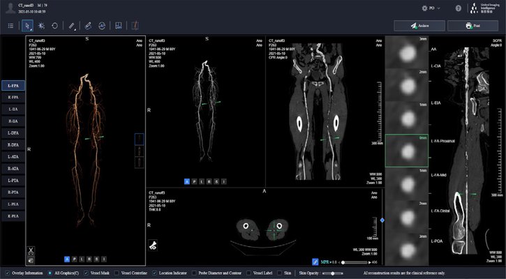 Lower Extremity Vessel Analysis