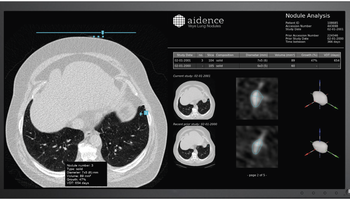 aidence-veye-lung-nodules.png