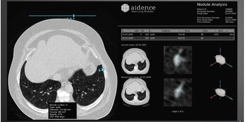 aidence-veye-lung-nodules.png