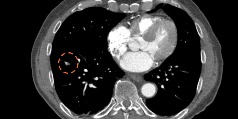 aidoc-incidental-pulmonary-embolism.png