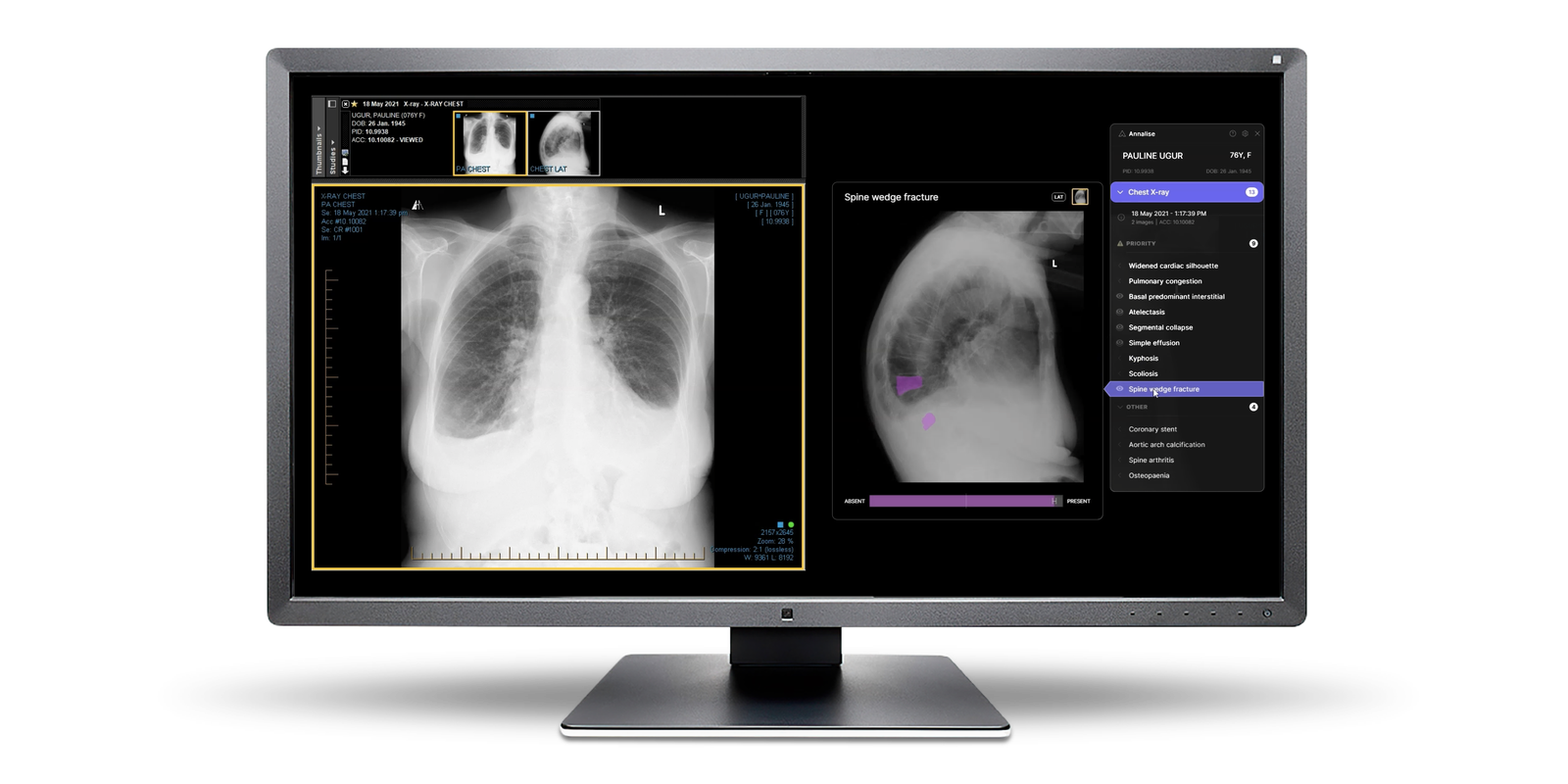 A third of all chest x-rays in the UK to be read with help of AI | News