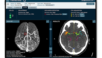 brainomix-e-cta.png