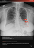 carebot-ai-cxr-1