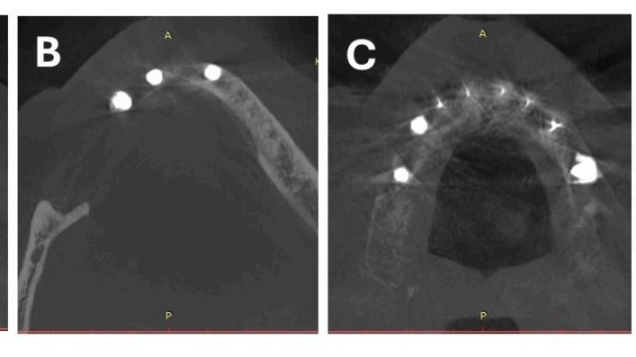 Reducing noise and metal artifacts in oral CBCT using AI | News