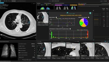contextflow ADVANCE Chest CT 3.0 - INSIGHTS with mSI Report
