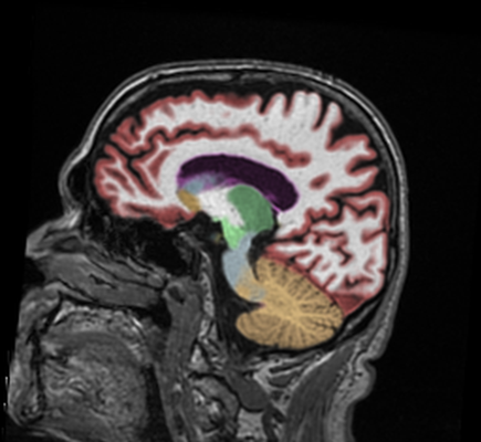 cortechs-ai-neuroquant-brain (1).gif