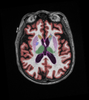 cortechs-ai-neuroquant-brain (13).png