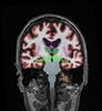 cortechs-ai-neuroquant-brain (14).png