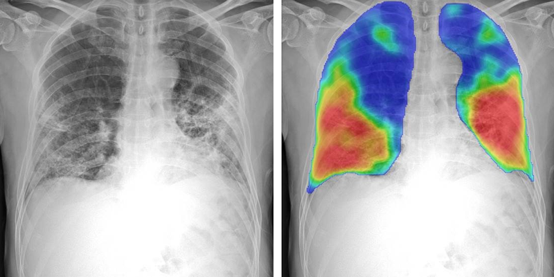 Community-based tuberculosis screening using AI-assisted chest x-rays ...