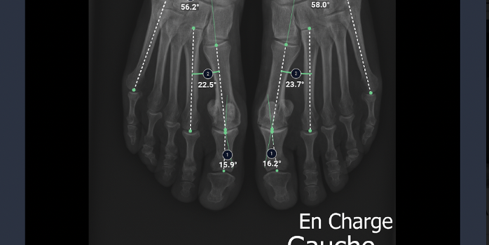 gleamer-ai-boneview-measurements.png