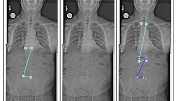 gleamer-bonemetrics-spine