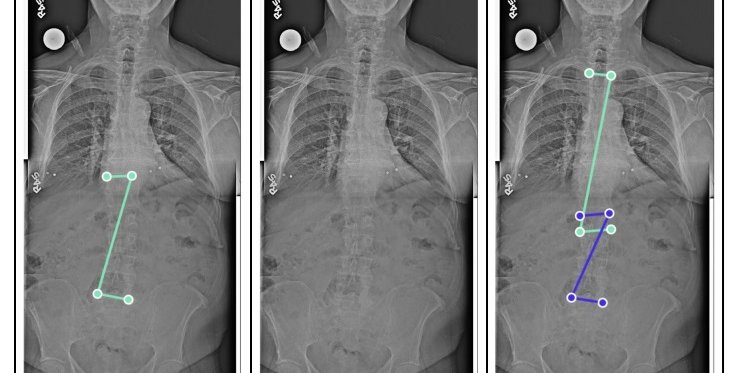 gleamer-bonemetrics-spine