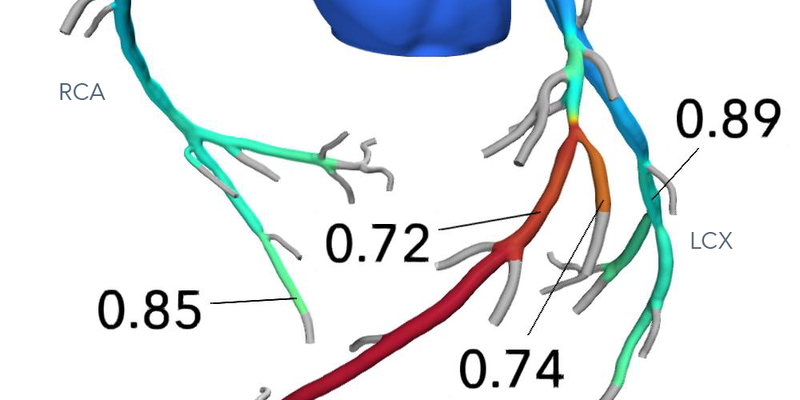 heartflow-ffrct-analysis_1.png