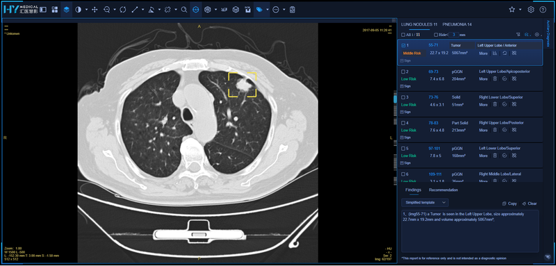 hy-medical-ct-lung-nodule.png