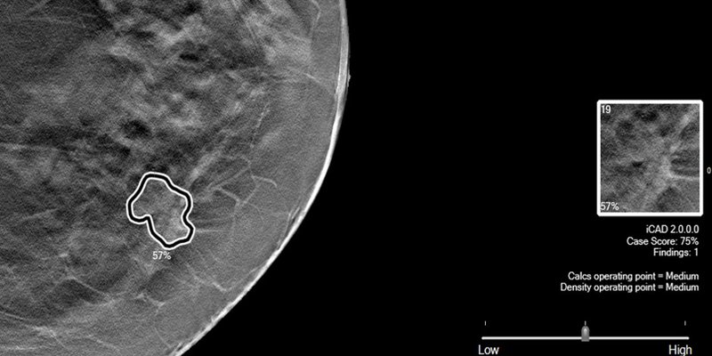 icad-profound-ai-for-2d-mammography.jpg