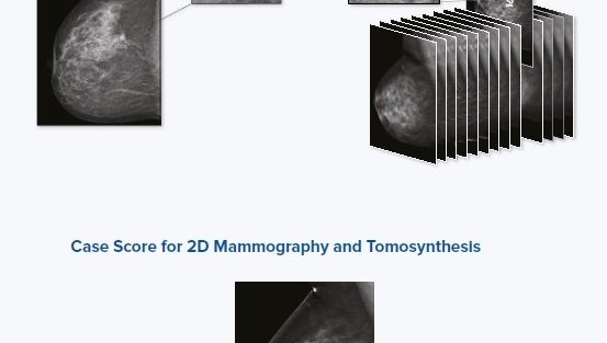 icad-profound-ai-for-2d-mammography.jpg