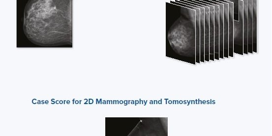icad-profound-ai-for-digital-breast-tomosynthesis_1.jpg
