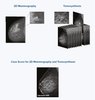 icad-profound-ai-for-digital-breast-tomosynthesis.jpg