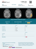 icometrix-icobrain-aria