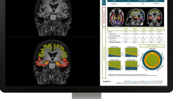 icometrix-icobrain-dm.png