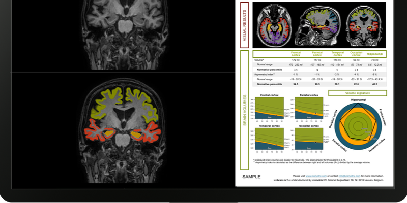 icometrix-icobrain-dm.png