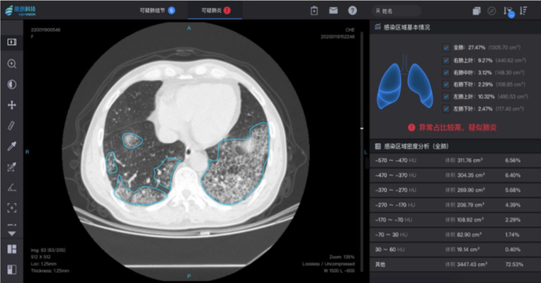 infervision-ct-pneumonia.png
