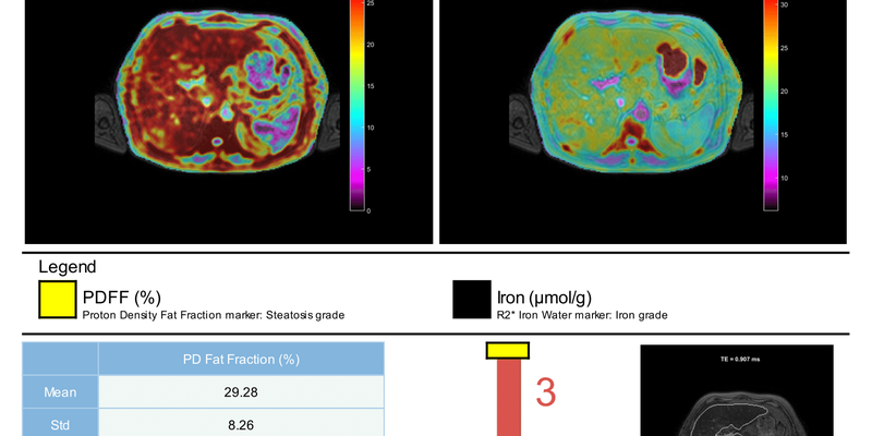 quibim-perfusion-liver-fat-iron-concentration.png