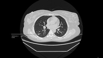 qureai-qct-lung_1.jpg