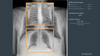 rayscape-chest-x-ray_1.png