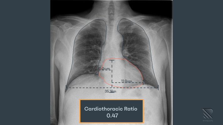 rayscape-chest-x-ray_2.png