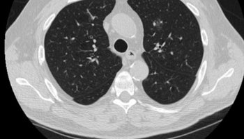 riverain-clearread-ct-detect.jpg