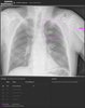 siemens-rad-companion-chest-x-ray.png